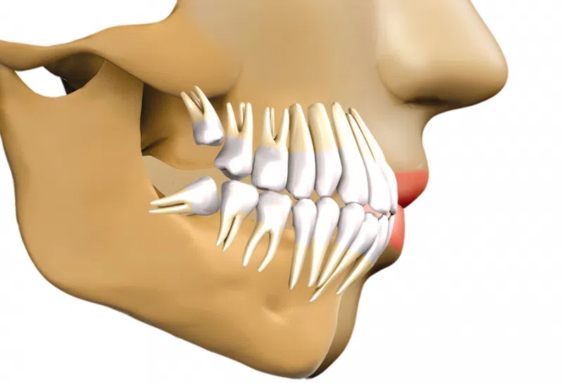სიბრძნის კბილები - რა უნდა ვიცოდეთ მათ შესახებ - მკურნალი.გე