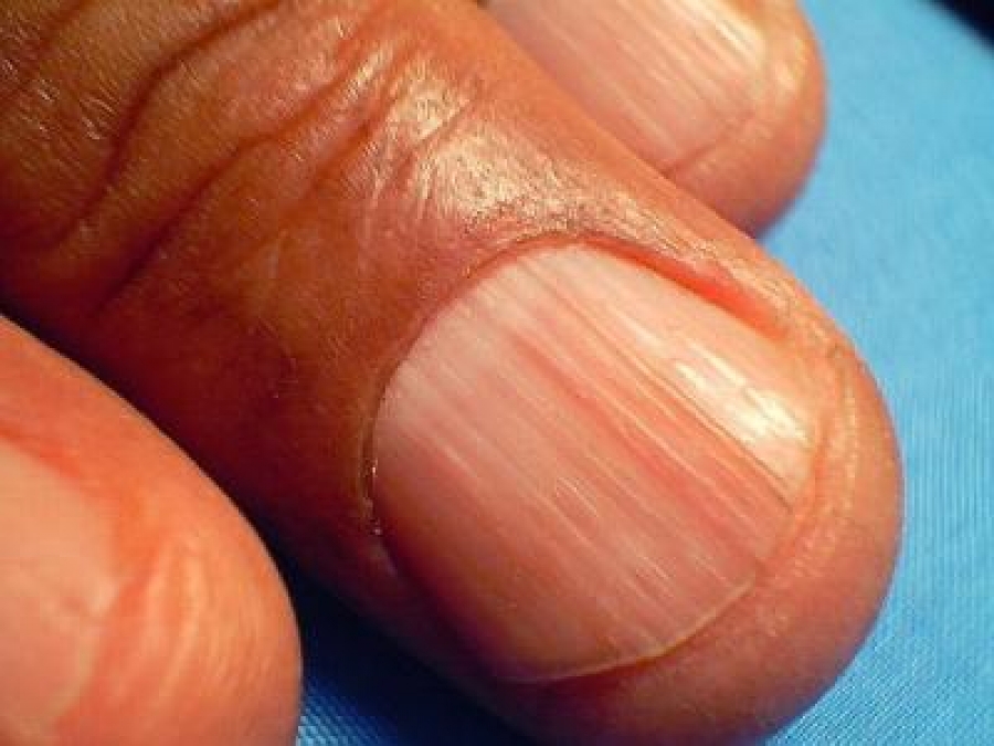 Humedad en las uñas