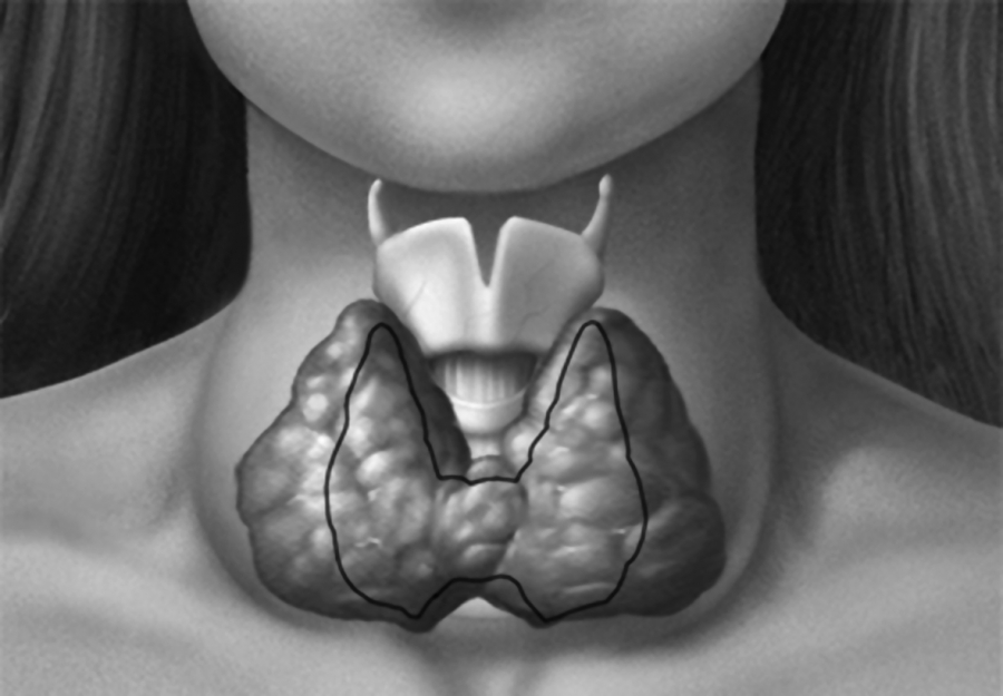 Зоб в горле. Асимметрия щитовидной железы.