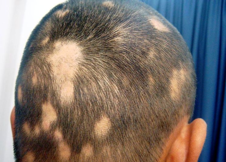 ალოპეცია - Alopecia - алопеция