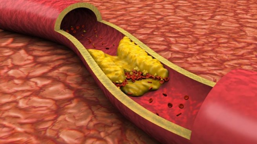 ათეროსკლეროზი - Atherosclerosis - атеросклероз