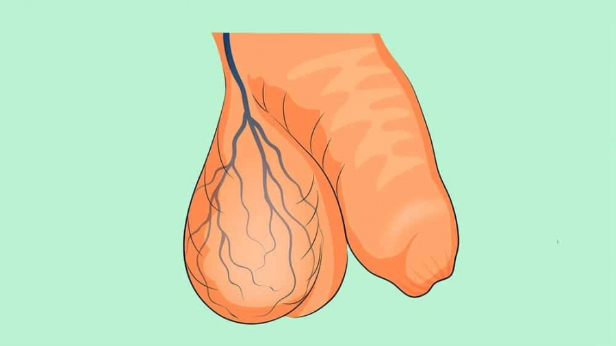 ვარიკოცელე - varicocele - варикоцеле