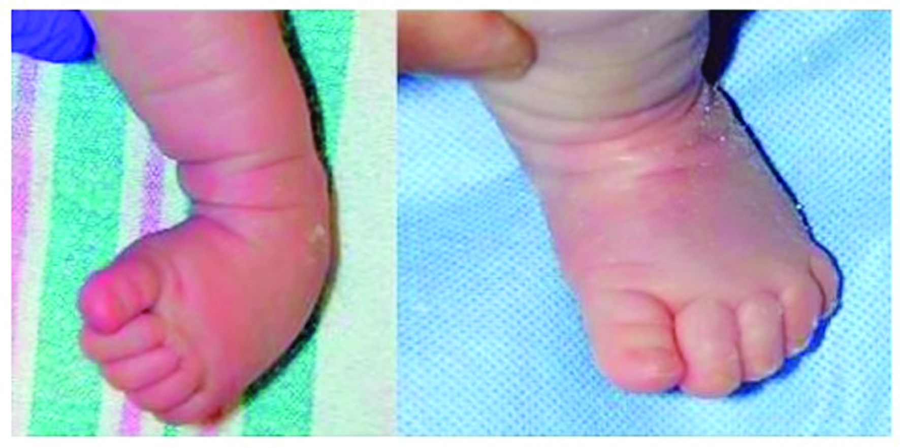 clubfoot-before-and-after-1645550777.jpg