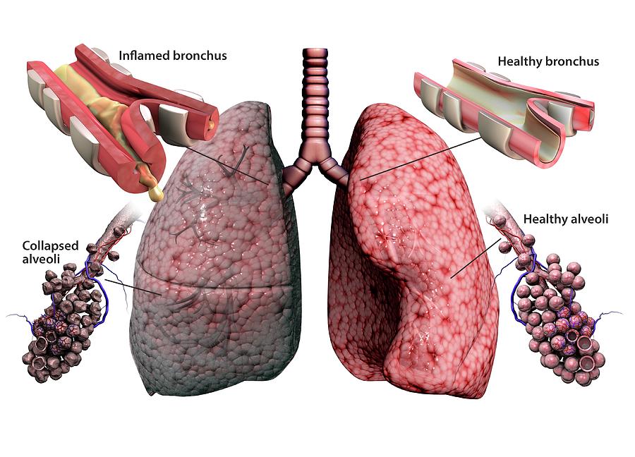 chronic-obstructive-pulmonary-disease-gunilla-elamscience-photo-library-1670918197.jpg