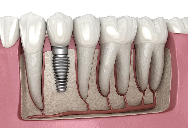 dental-implant-illustration-1723751545.jpg