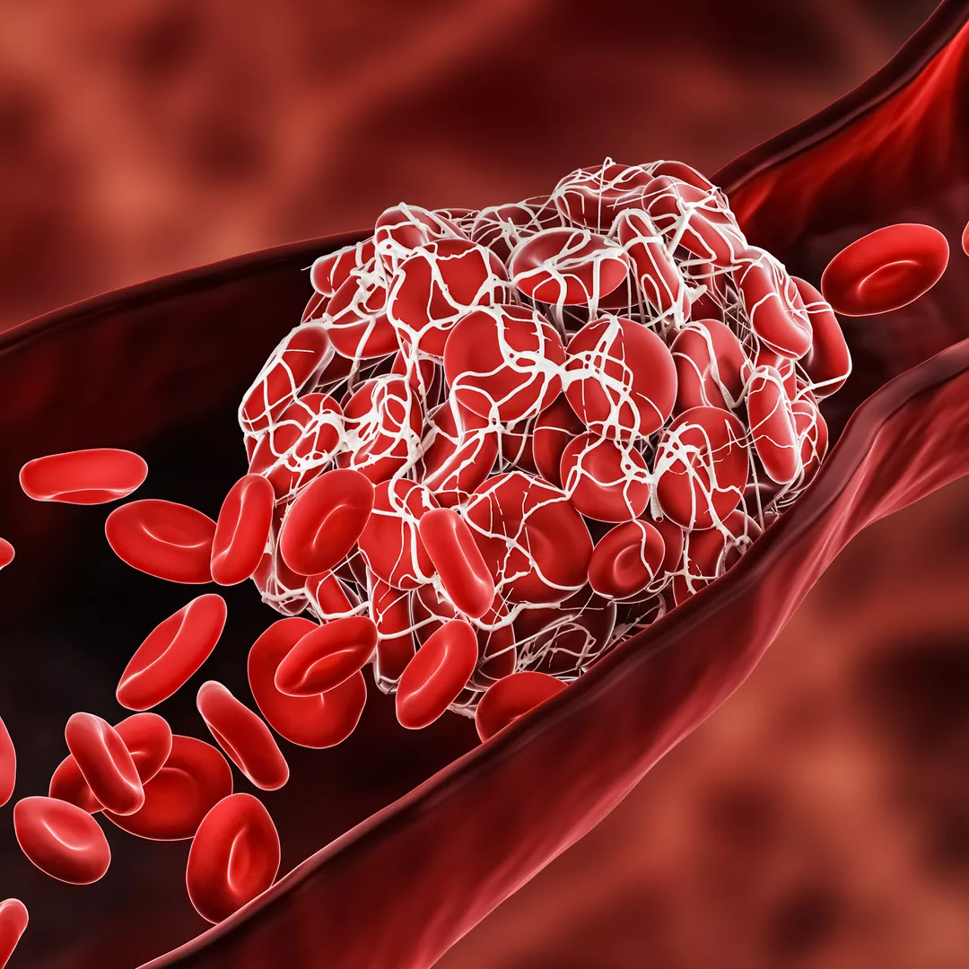 blood-clot-istock-1297034329-w1080-h1080-1776502956.webp