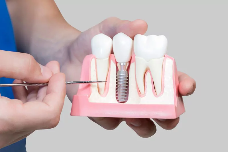 dental-implant-model-bone-cutaway-4-1778870566.webp