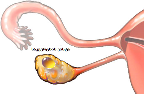 ovarian-cyst-1783122195.png