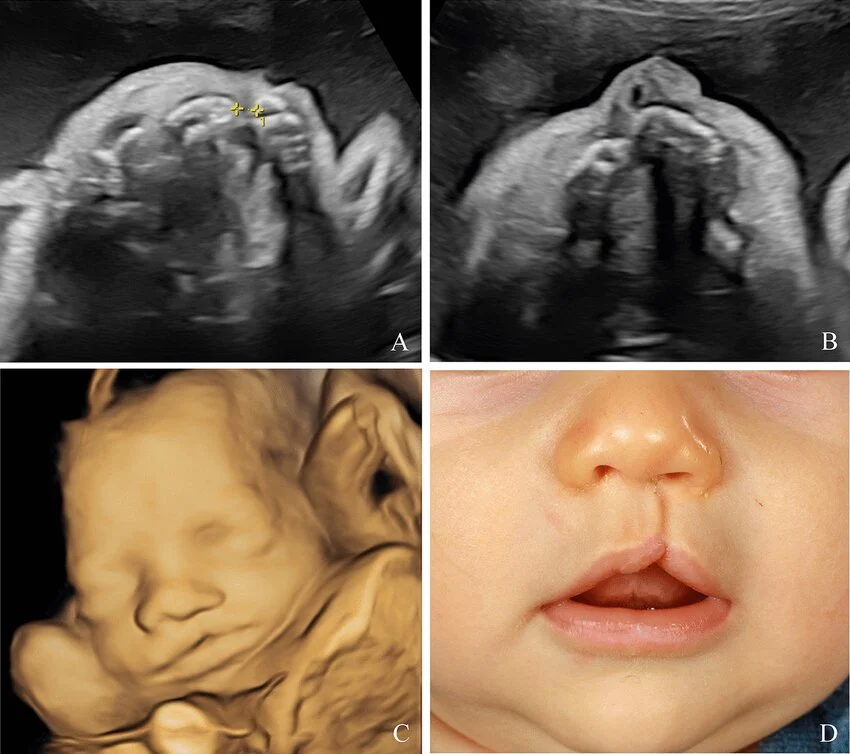 unilateral-cleft-lip-and-palate-visualized-on-ultrasound-during-the-prenatal-period-in-1-1788902642.webp